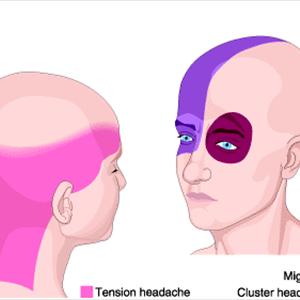 Headache Medicine For Pregnant Women - Prevent A Migraine Headache