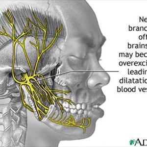Vestibular Migraine Causes - Is There A Way To Prevent Migraine Headaches