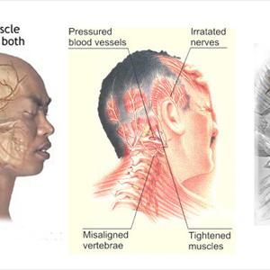 Condition Headache Migraine More Symptom - Rebound Headache - How To Escape