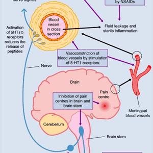 Causes Of Bickerstaffs Migraine - Migraine 101