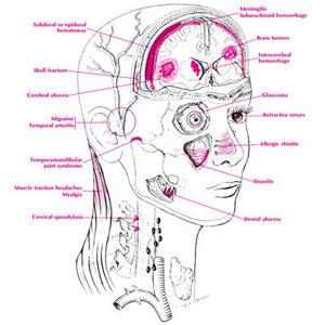 Acute Migraine Medication - Beating Migraine Pain