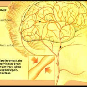 Migraine And Focus Problem - Set Up Your Migraine Support System - Talk To The People Who Matter 