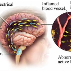 Migraines Information - Childhood Migraine Home Remedies  - Safe Natural Cures That Stop The Pain Fast